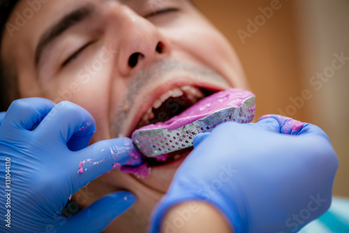 Dental Impression