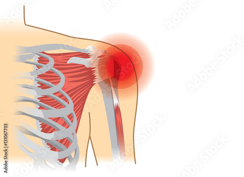 Human shoulder muscles and joints have a red signal. Illustration about chronic pain.