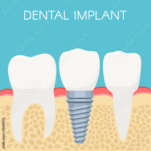 Human teeth and Dental implant