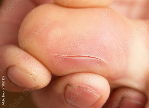 Fényképezés a cut on the finger skin