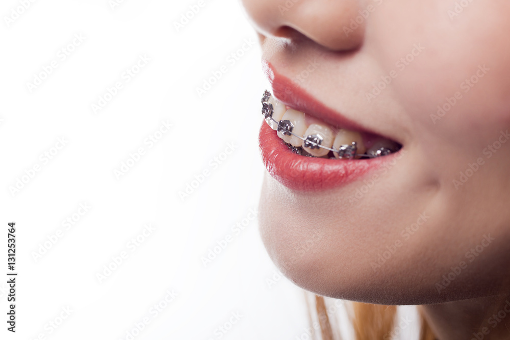 closeup of the teeth and braces closeup of the teeth and braces