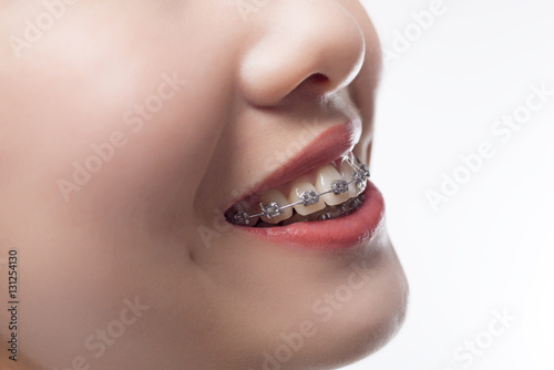 Portrait of a girl with braces photo
