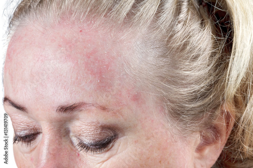 Mature woman's very dry skin from seborrheic dermatitis photo
