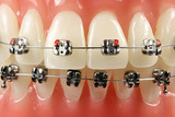 Zahnmodell mit festsitzender Zahnspange