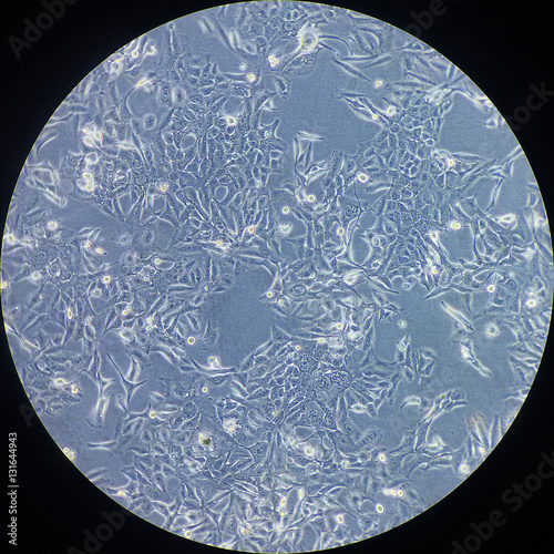 Photography Cancer cells under microscope