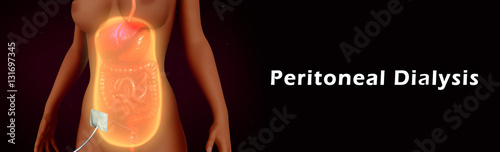Peritoneal Dialysis
