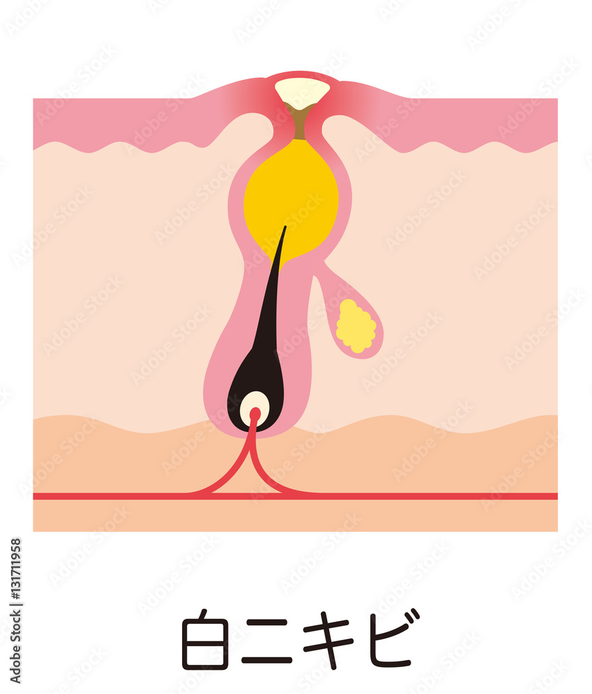白ニキビ ニキビの仕組み 毛穴の構造 Stock イラスト Adobe Stock