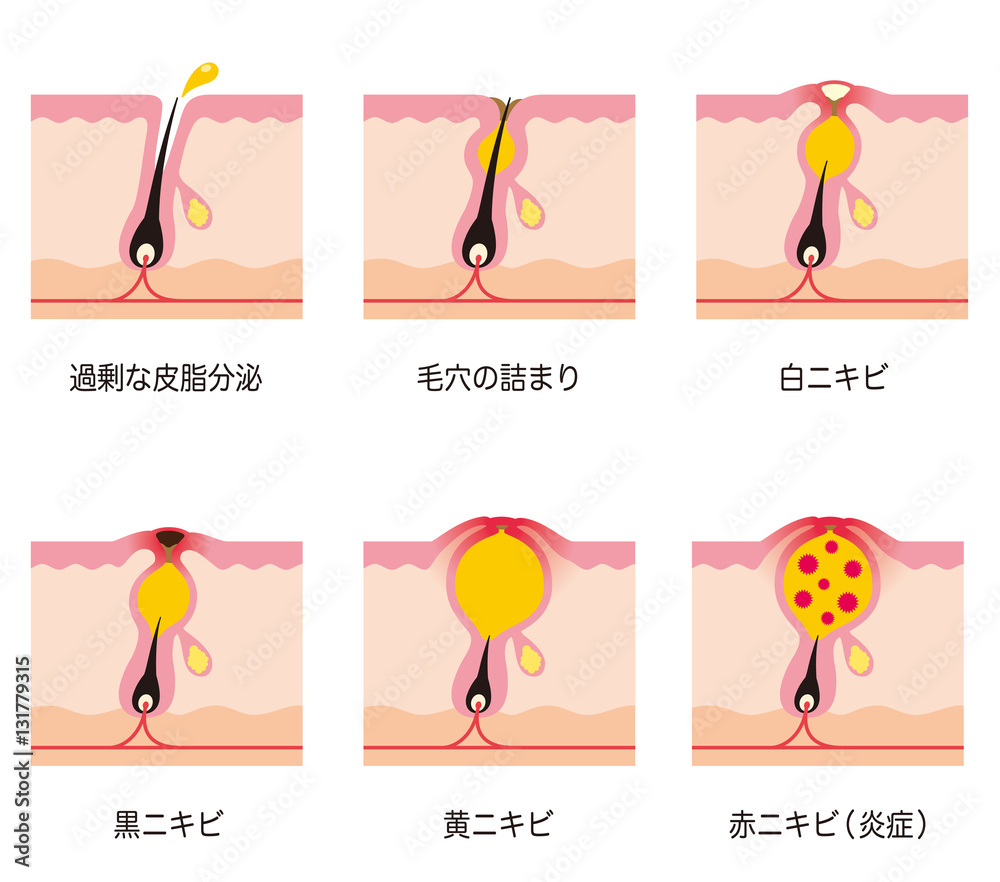 ニキビの症状 毛穴 断面図 Stock イラスト Adobe Stock