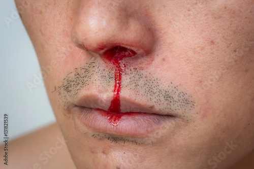 nosebleed , A man is bleeding from his nose. photo