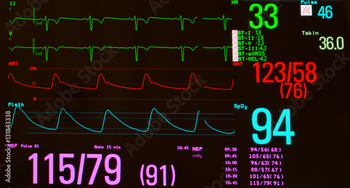 Monitor with EKG with significant sinus bradycardia (green line), arterial blood pressure (red line), oxygen saturation (blue line) and noninvasive blood pressure against a black background 
