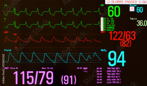 Close up of EKG or electrocardiogram showing paced rhythm with premature beat (green lines), arterial blood pressure (red line), oxygen saturation  (blue line) and noninvasive blood pressure.