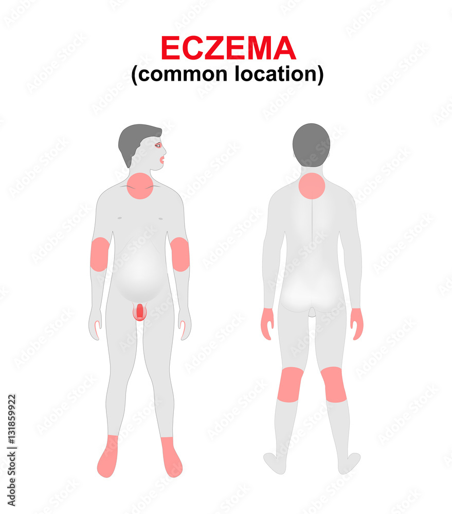 Eczema, dermatitis. Areas of the body most commonly affected. Stock