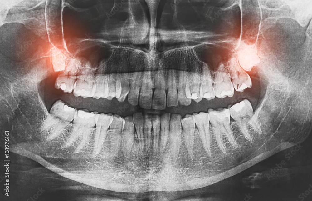 Obraz premium Closeup of x-ray image growing wisdom teeth pain concept.