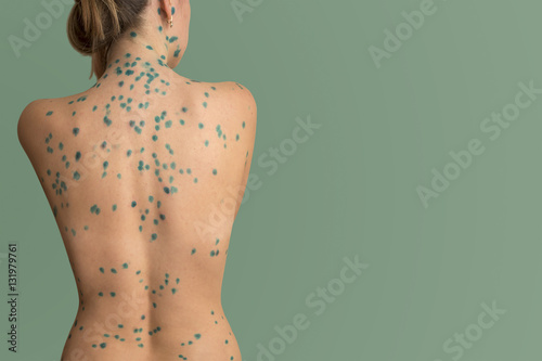 Obraz na plátně woman back ailing chickenpox