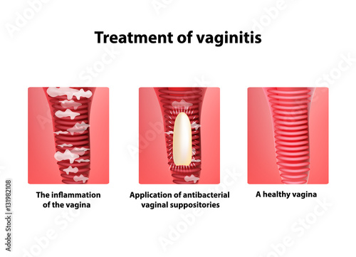 Treatment of vaginitis suppositories. inflammation  the vagina. Infographics. vector illustration on isolated background