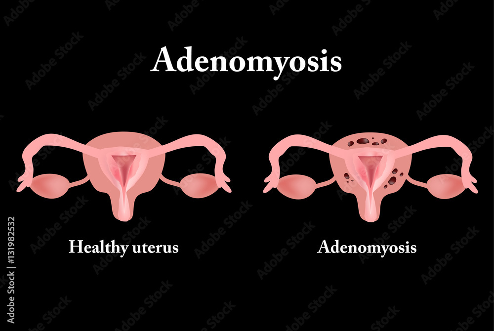 Endometriosis The Structure Of The Pelvic Organs Adenomyosis The Endometriosis The Structure Of The Pelvic Organs Adenomyosis The