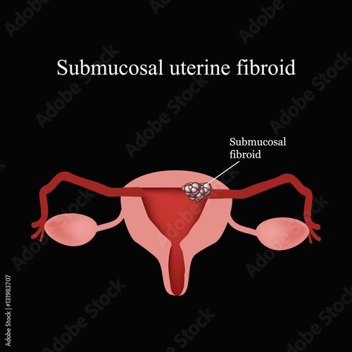 Submucosal fibroids. Endometriosis. Infographics. Vector illustration on a black background