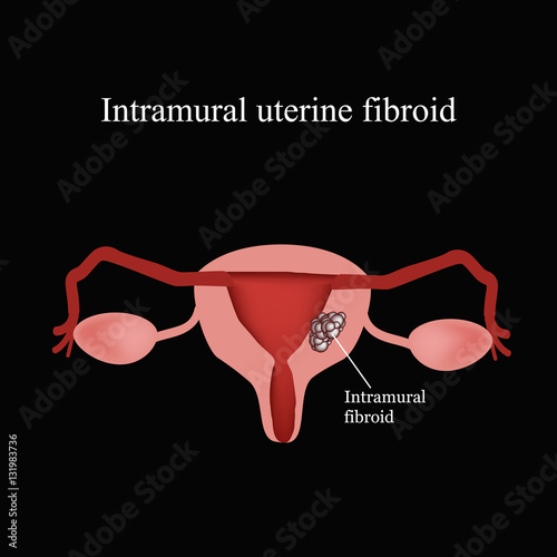 Intramural fibroids. Endometriosis. Infographics. Vector illustration on a black background