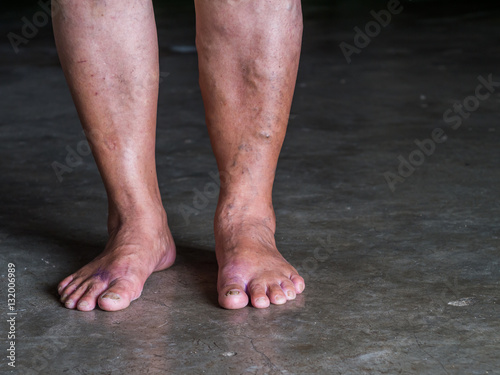 The varicose veins on a legs