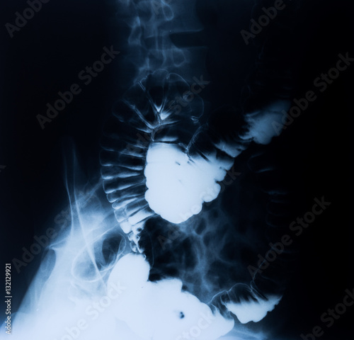 Röntgenbild eines menschlichen Darms