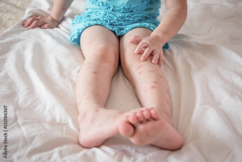 Mosquito bites sore and scar on child legs Mosquito bites sore and scar on child legs