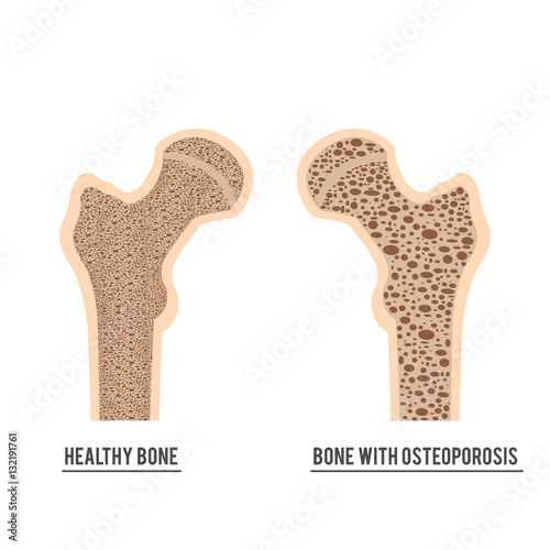 normal bone and bone with osteoporosis