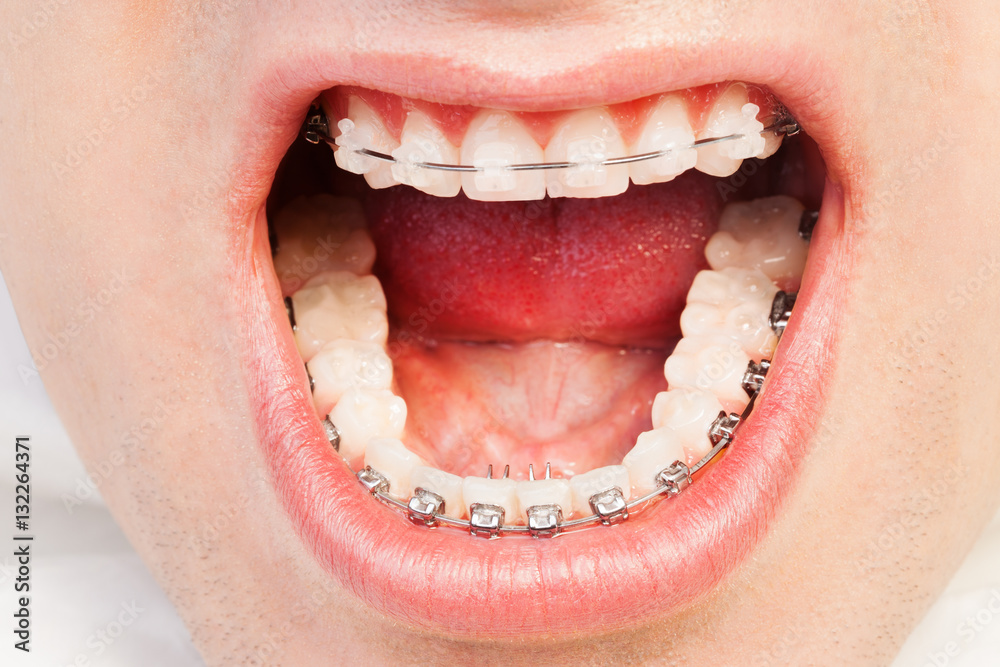 Naklejka premium Wide opened mouth with self-ligating brackets