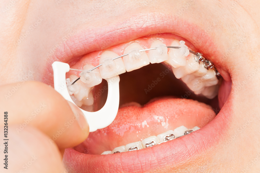 Fototapeta premium Man with braces using floss for upper jaw hygiene