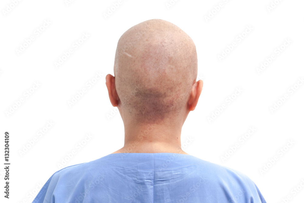Hair loss patient after chemotherapy on white background isolated