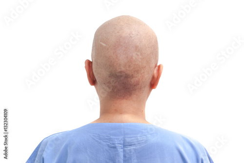 Obraz na płótnie Hair loss patient after chemotherapy on white background isolated w salonie