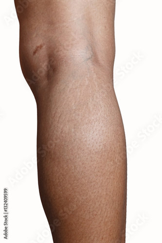 leg Skin stretch marks