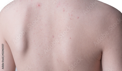 Closeup isolated acne on a woman back