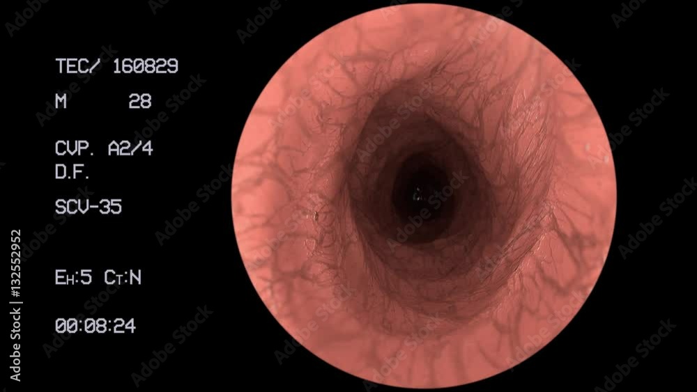 Colon 4k Endoscope medical camera gut intestine colon doctor endoscopy surgery ...