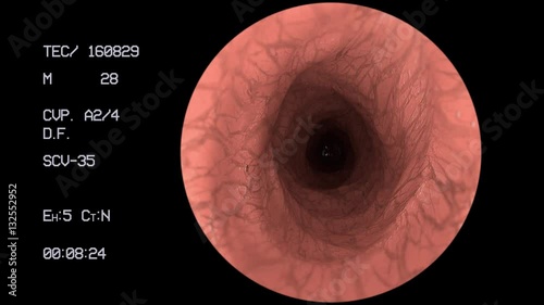Endoscope medical camera gut intestine colon doctor endoscopy surgery 4k