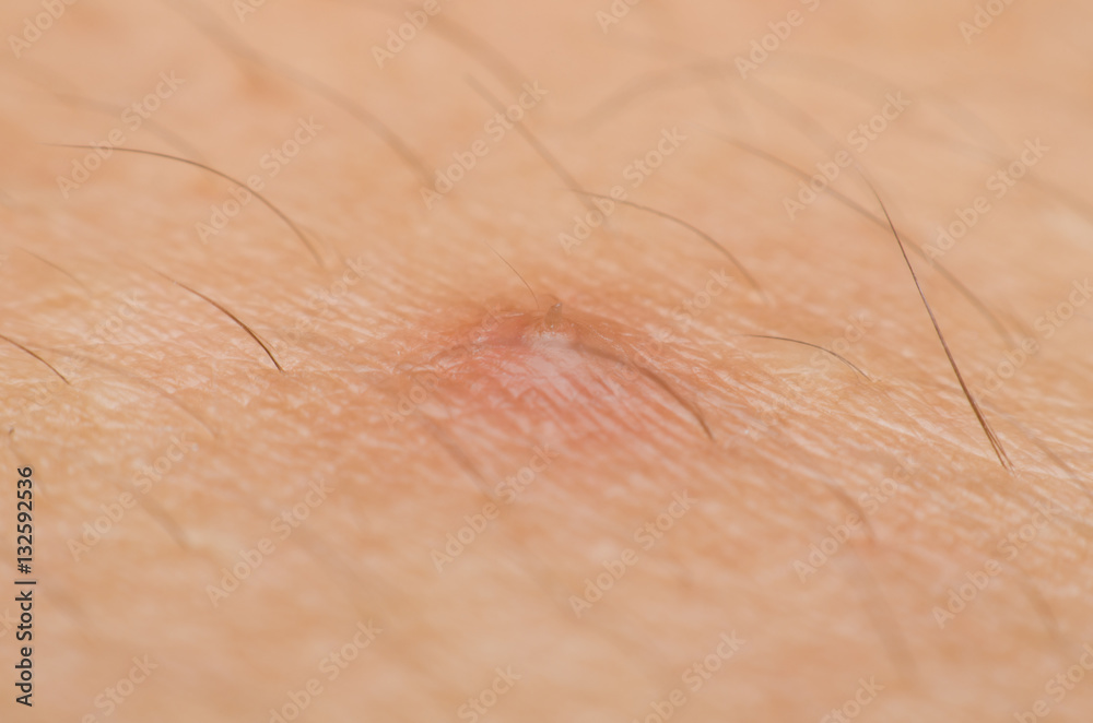 Fototapeta premium macro to close up acne on women skin