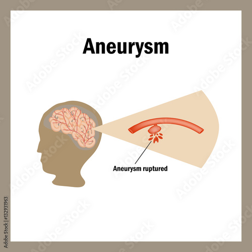 Break anevrizmy.Krovoizliyanie brain. Stroke, atherosclerosis, aneurysm. Cholesterol plaques. Infographics. Vector illustration