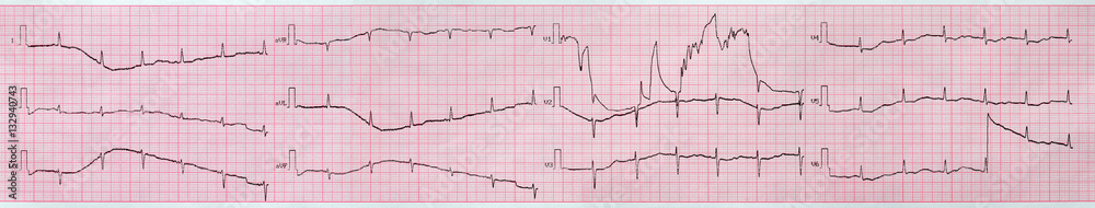 Electrocardiogram