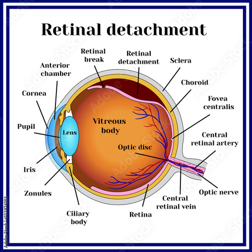 Retinal detachment. Detachment of the retina from choroid. photo