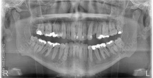 Panoramic dental RTG (X-Ray) of teeth. Monochrome facial image.