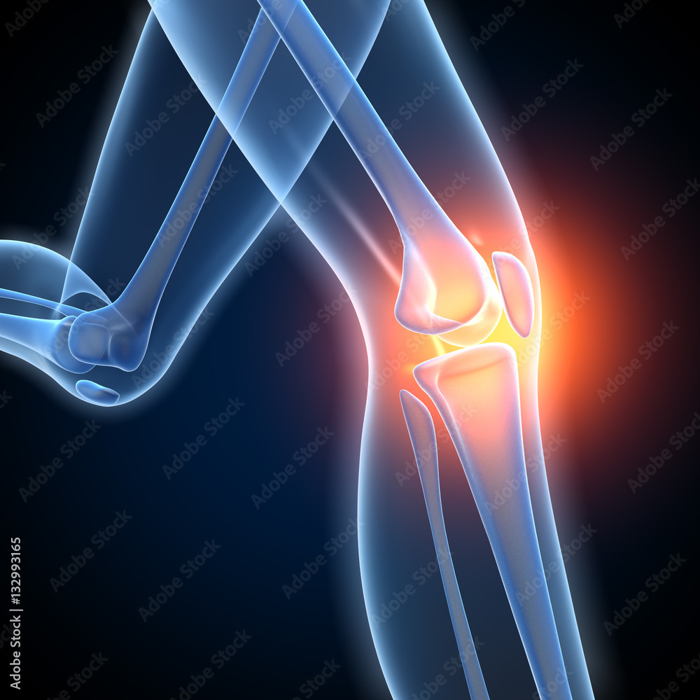 Arthritis, rheumatoid arthritis, medical illustration Stock
