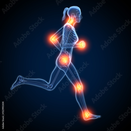 Arthritis, rheumatoid arthritis, medical illustration