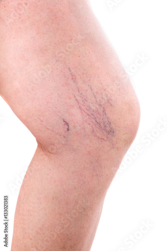 leg with spider veins