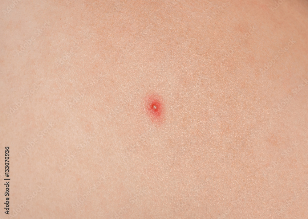 Fototapeta premium Big red pustules on the skin close-up. Beauty and skin care.