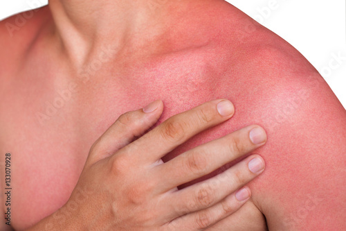 A man with reddened itchy skin after sunburn. Skin care and protection from the sun's ultraviolet rays.