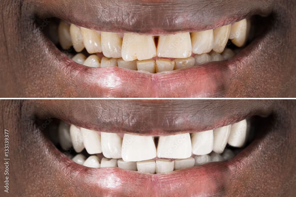 Man Teeth Before And After Whitening