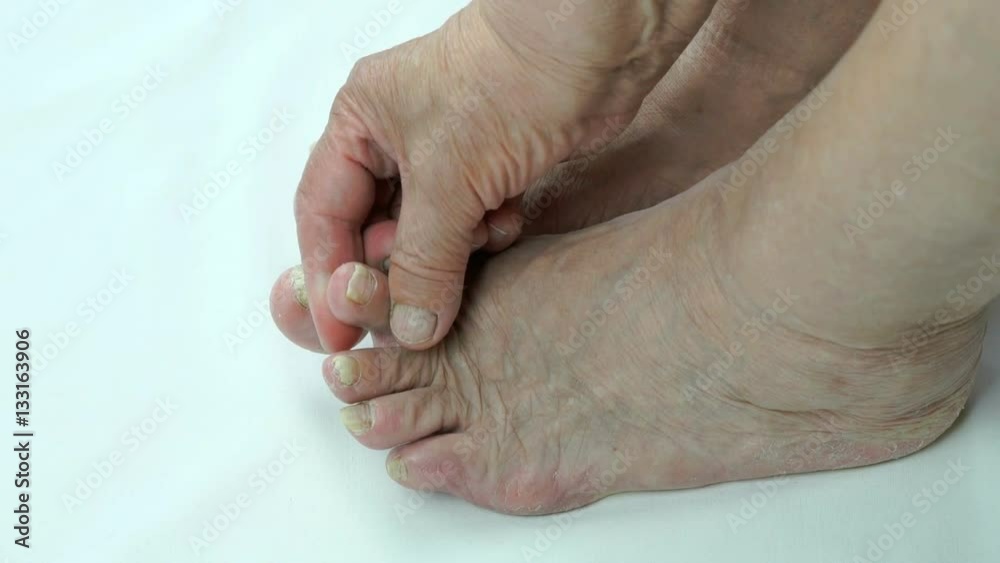 Serious fungal infection on nails of person's foot Serious fungal infection on nails of person's foot