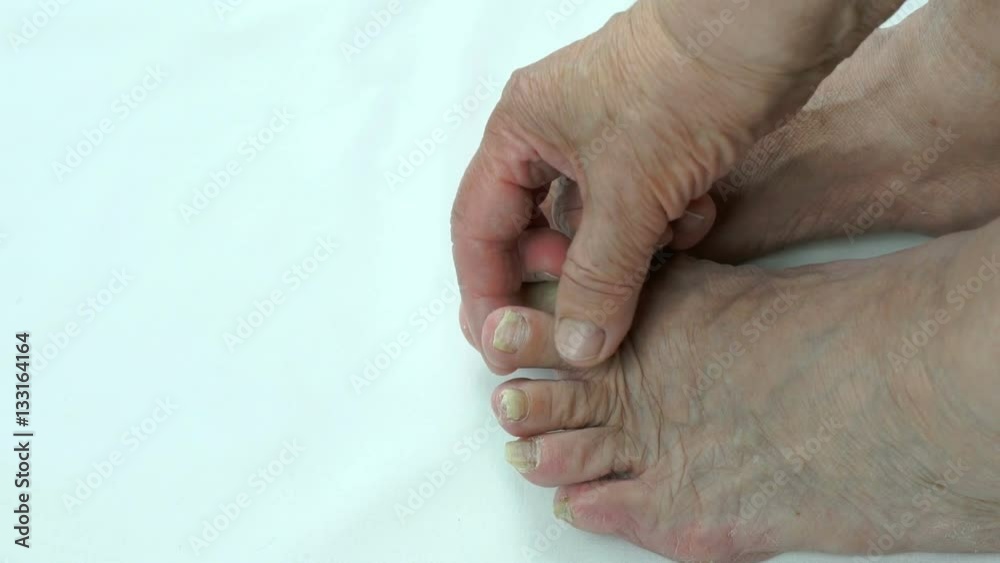 Onychomycosis. Fungus infection on nails of person's foot Onychomycosis. Fungus infection on nails of person's foot