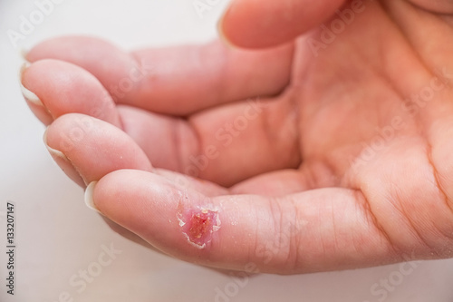Closed-up of a wound on finger © greentellect