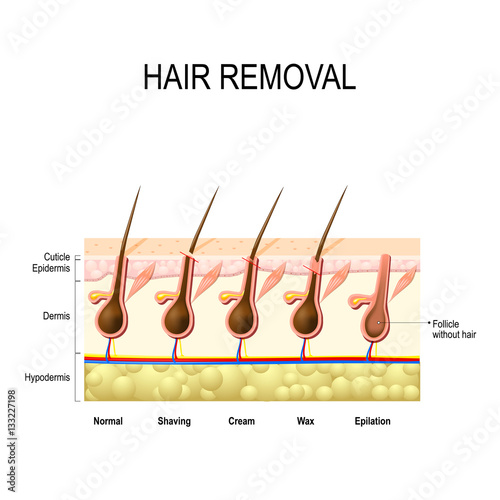Hair removal