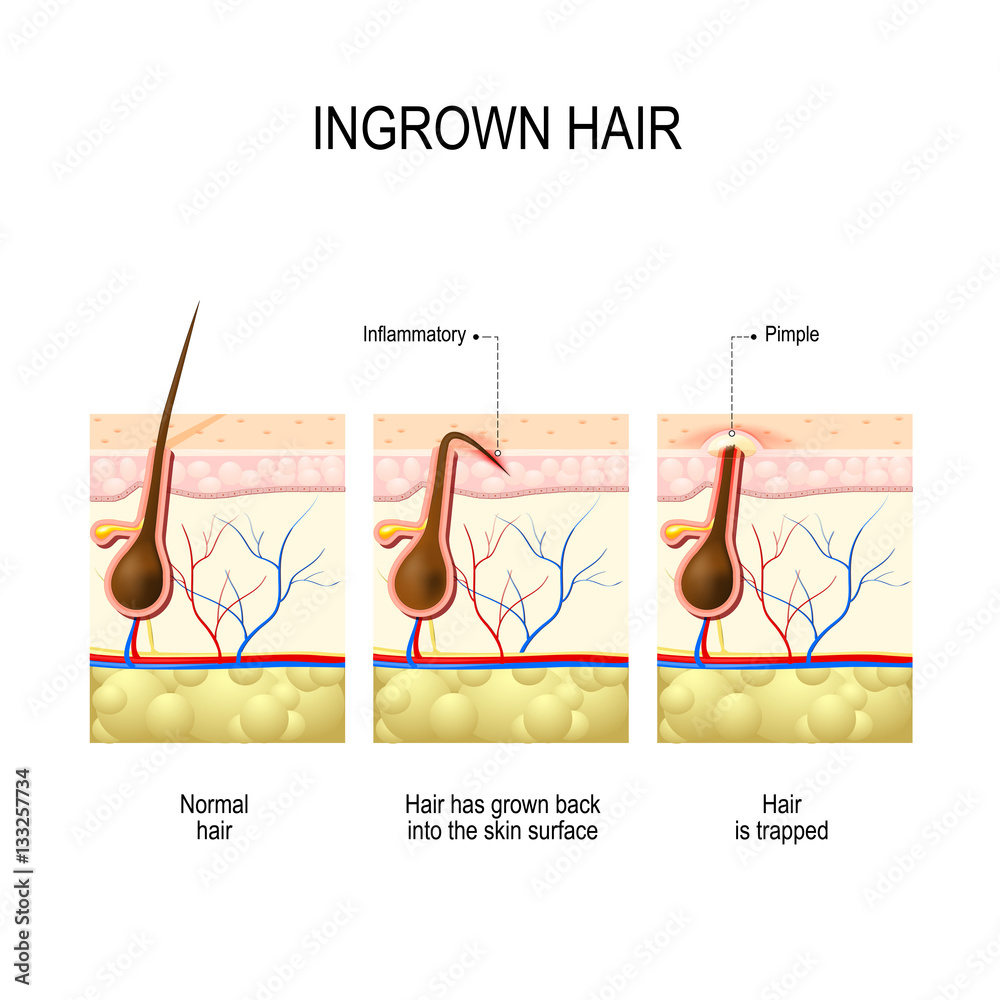 Ingrown hair after shave deals